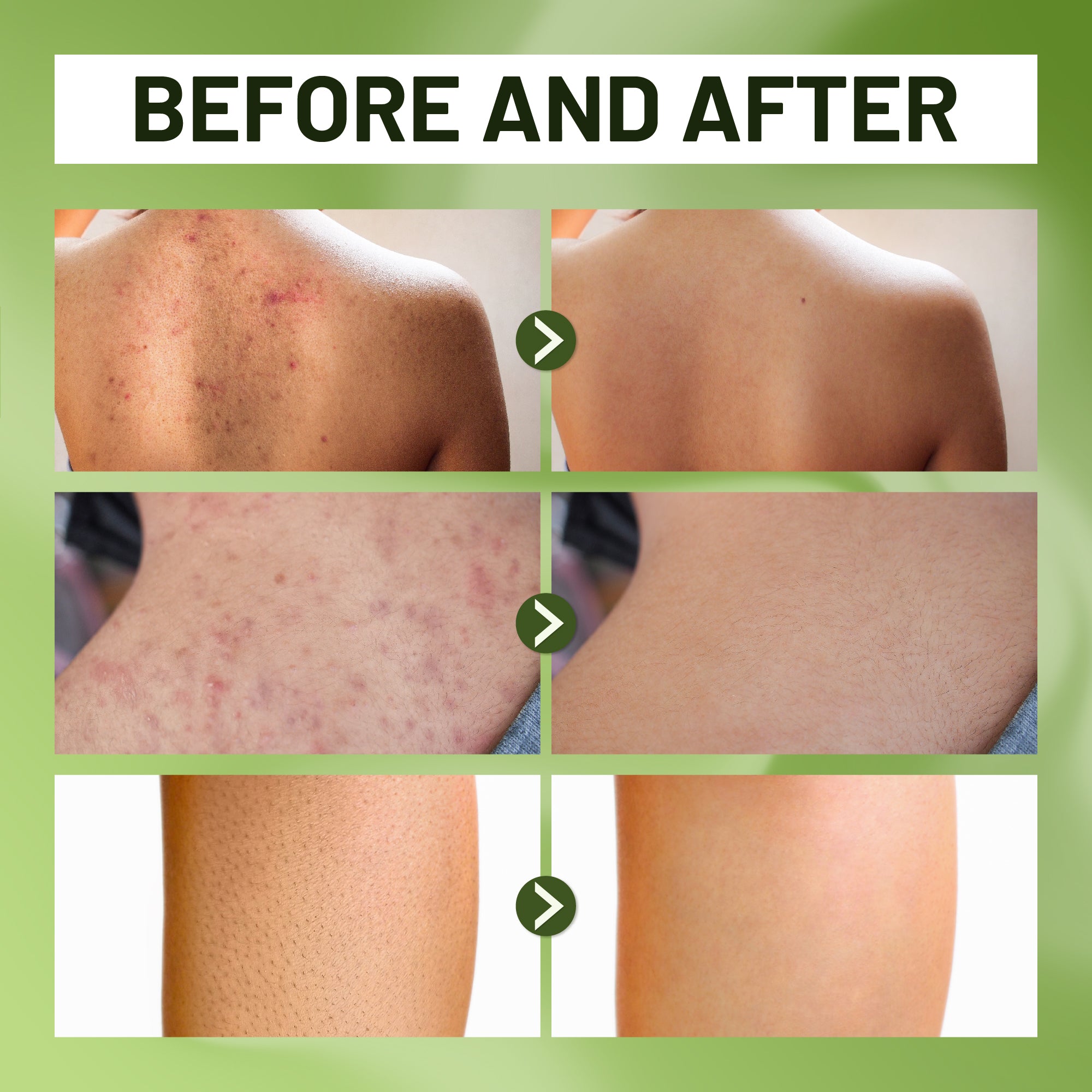 ABERA Folliculitis Shower Gel