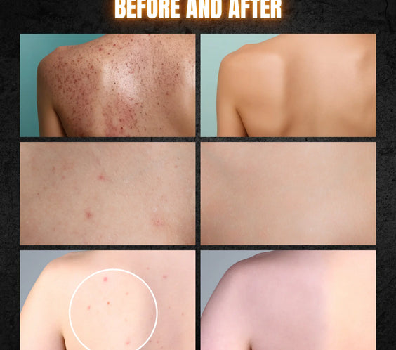 Acne Body Wash For Men