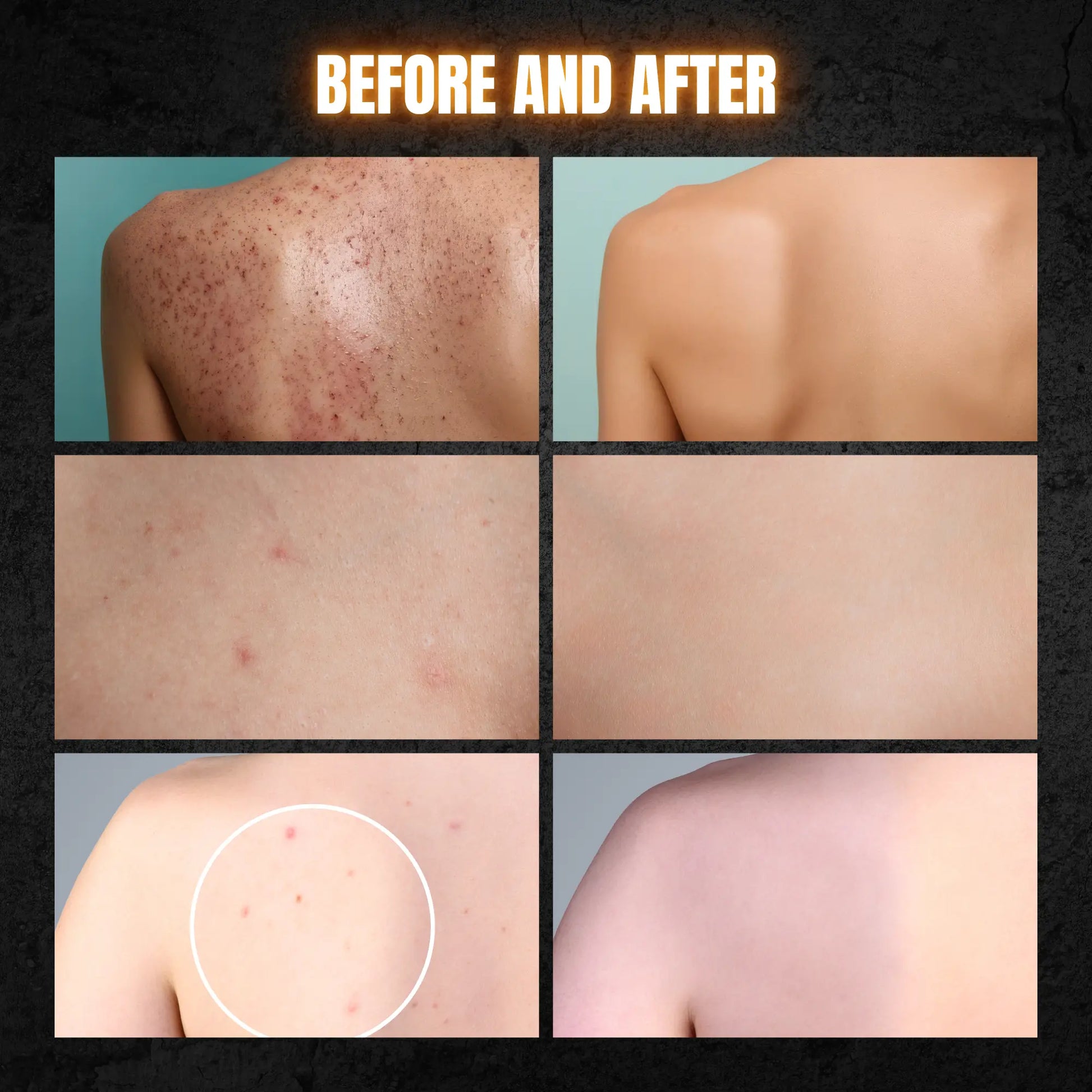 Acne Body Wash For Men