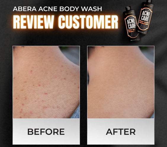 Acne Body Wash For Men
