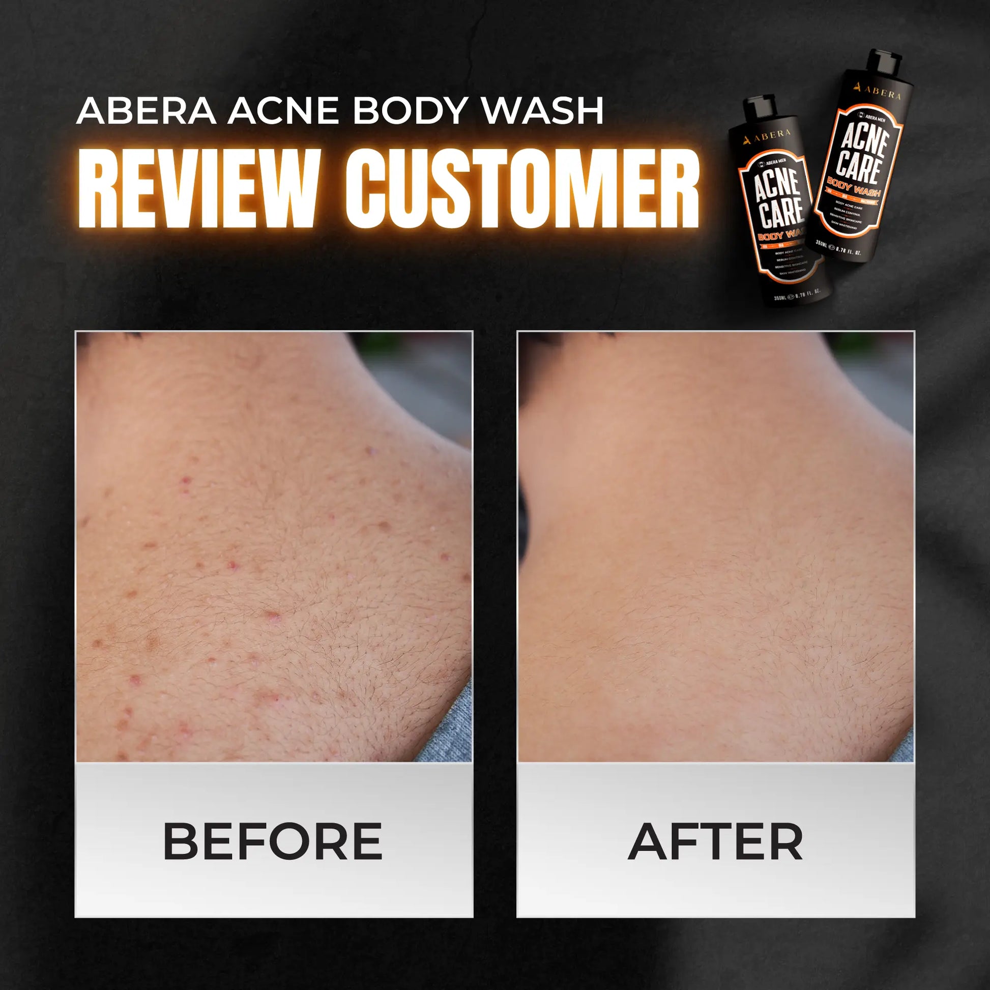 Acne Body Wash For Men