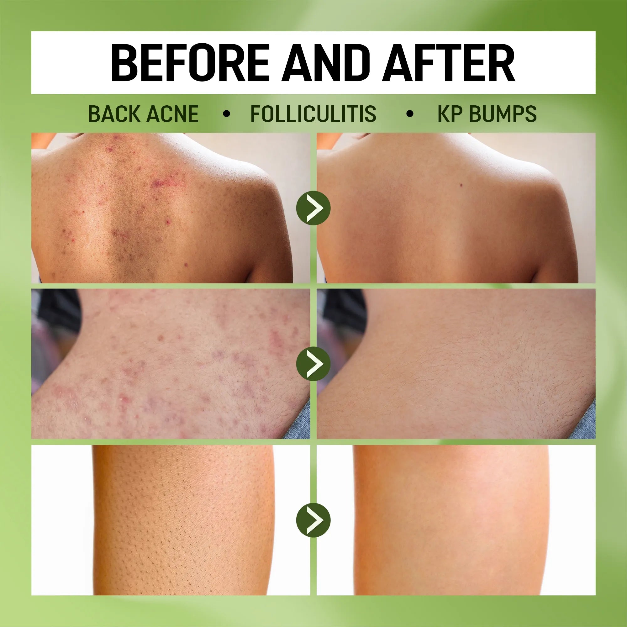 ABERA Folliculitis Body Wash, High-Performance BHA Shower Gel with Wild Bitter Melon Extract, 10.14 OZ