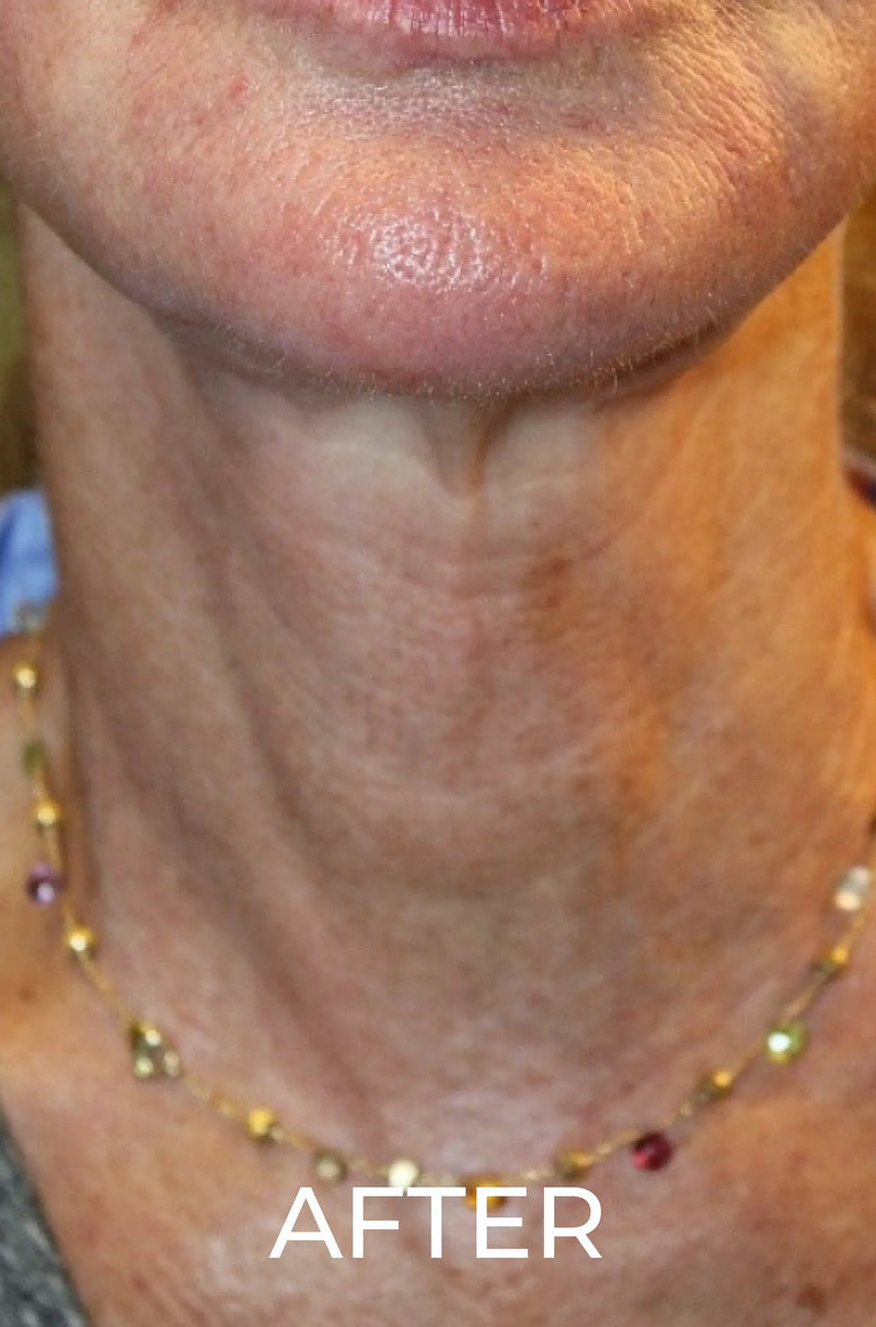 After — Saggy / Wrinkle Neck