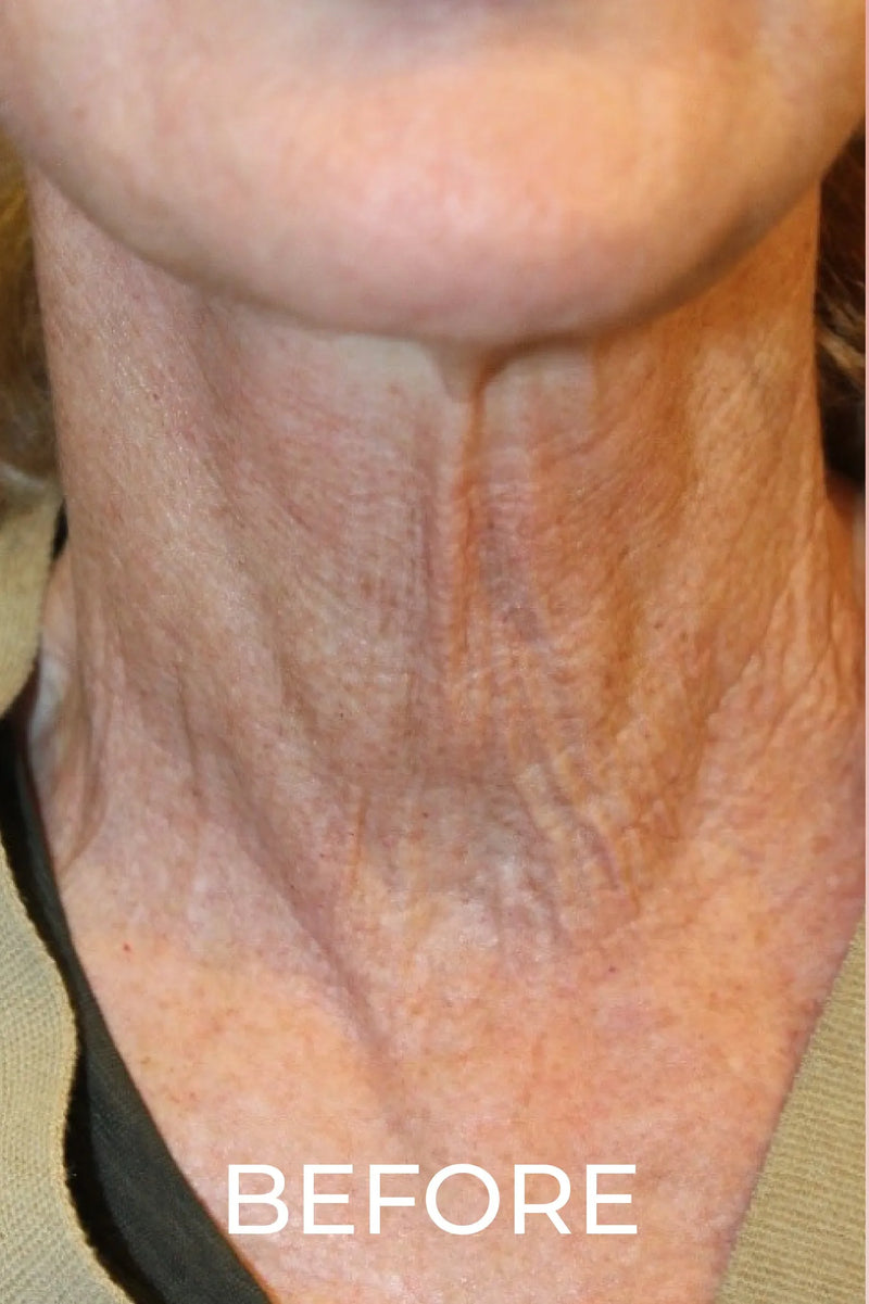 Before — Saggy / Wrinkle Neck